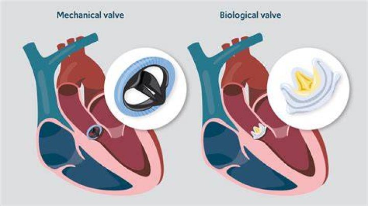 Can replacement heart valves fail?