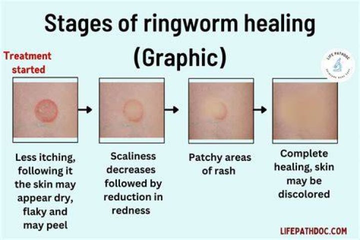 Does washing clothes remove ringworm?