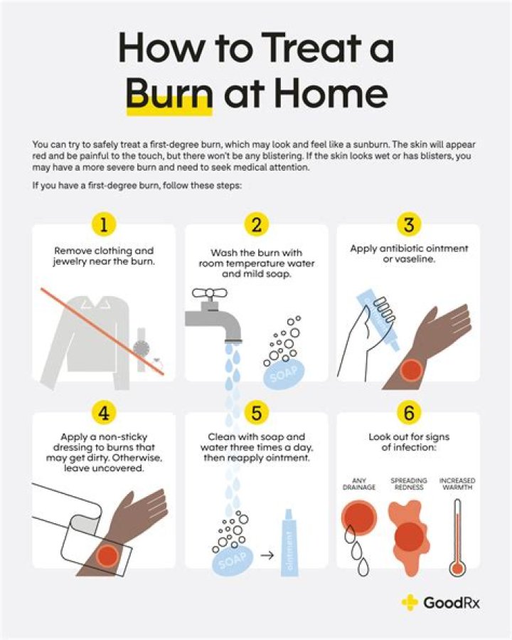 How do you treat a burn from boiling water for kids?