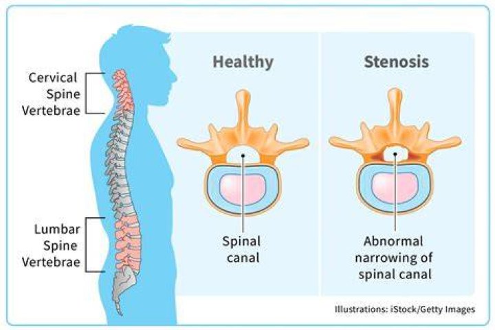 What does stenosis in C6 and C7 mean?