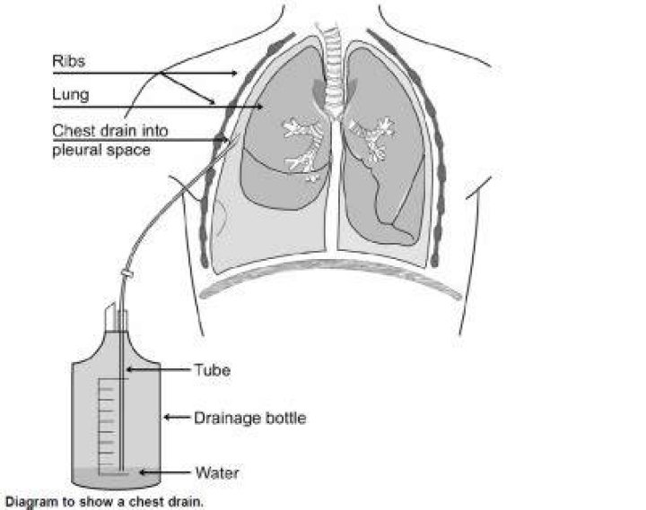 Where do you insert a chest drain?