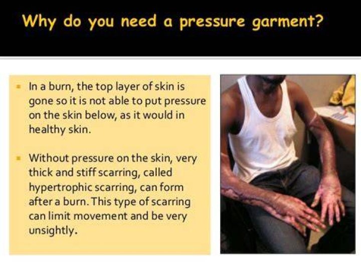 Why do burn survivors wear compression?