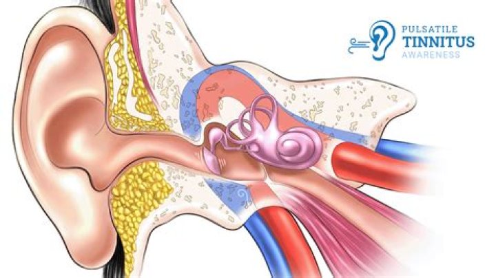 Why is my pulsatile tinnitus getting louder?